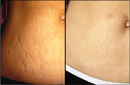 Skin Care &amp; Tanning - 25% STRENGTH TCA CHEMICAL PEEL AT ...